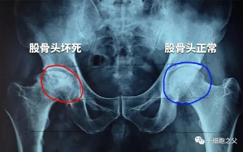 干细胞移植治疗116例股骨头坏死的前瞻性临床研究