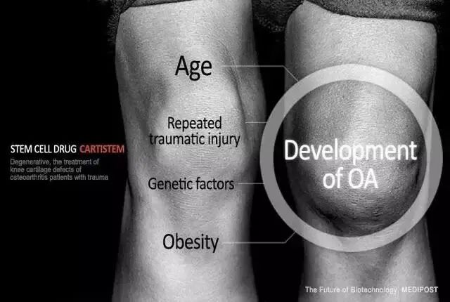 干细胞让骨关节炎患者软骨持续再生
