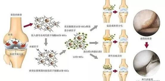 干细胞让骨关节炎患者软骨持续再生