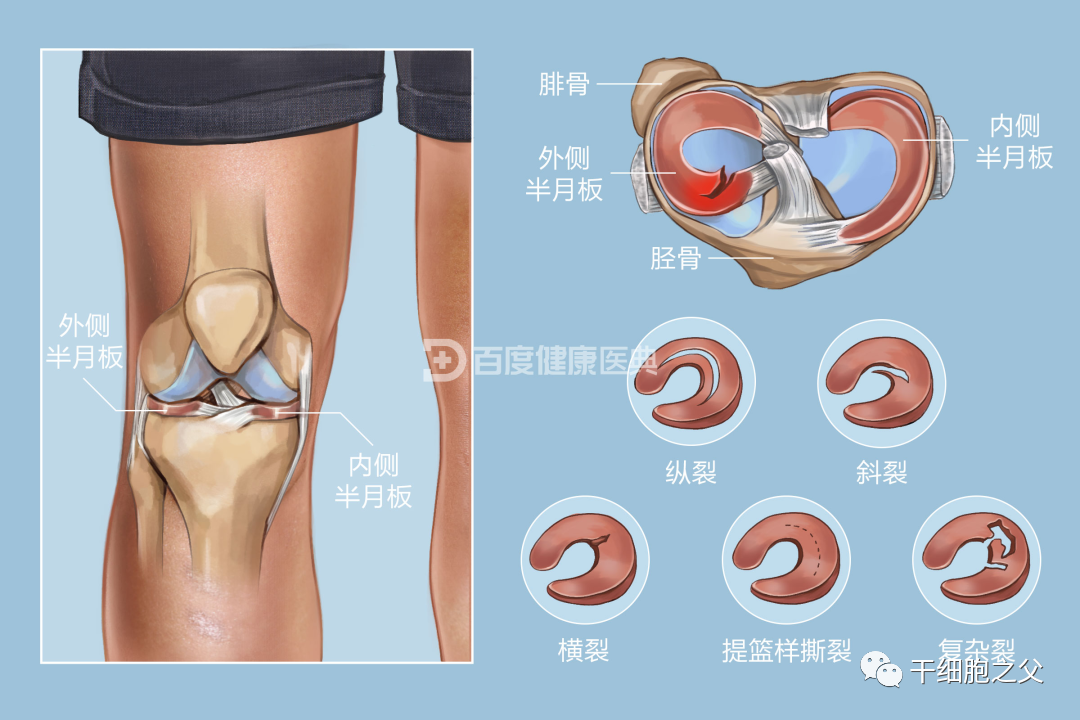 4个临床案例佐证：干细胞治愈半月板损伤更具有优势
