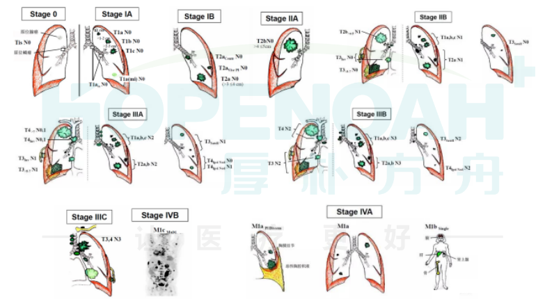 【肺癌手册】关于肺癌的症状、分期、治疗方案和生存率，这篇文总结全了！