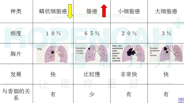 【肺癌手册】关于肺癌的症状、分期、治疗方案和生存率，这篇文总结全了！