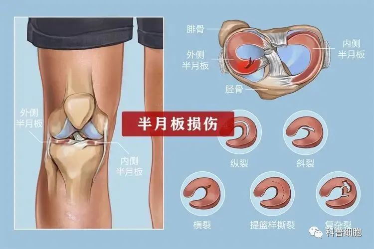 干细胞技术干预半月板损伤临床效果显著