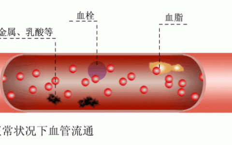 临床600+ | 干细胞有效改善脑梗后遗症！