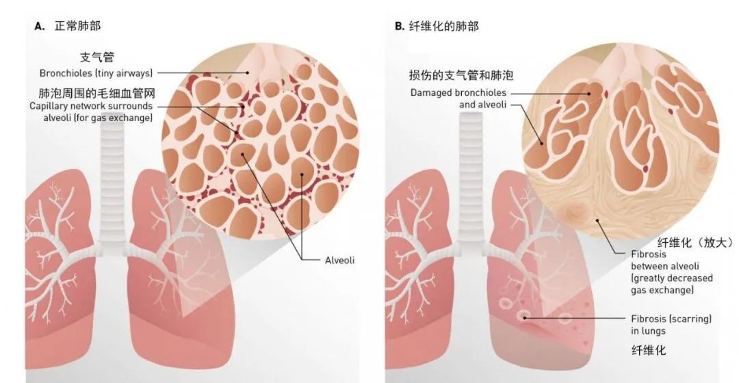 干细胞在肺纤维化的临床应用