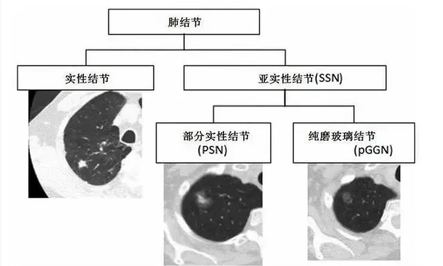 细胞疗法上演肺结节“消失术”，从根源扼杀一切可能的病变