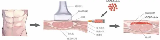 重磅！​我国科学家首次利用干细胞再生疗法功能性治愈1型糖尿病