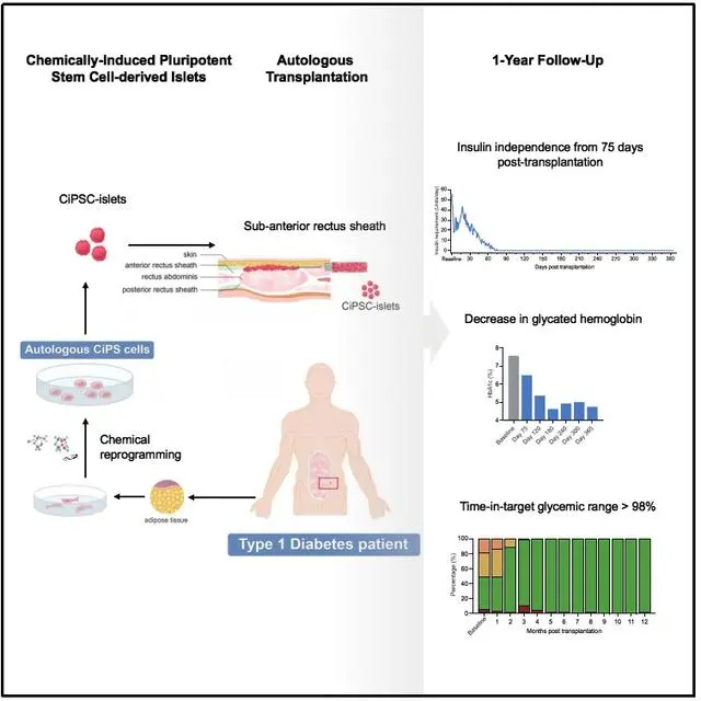 重磅！​我国科学家首次利用干细胞再生疗法功能性治愈1型糖尿病