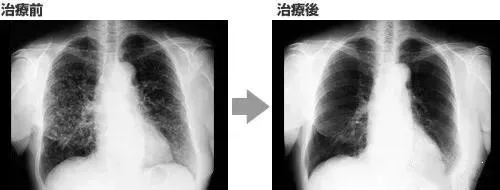 细胞科普｜免疫细胞界的较量：NK细胞和CIK细胞，谁更胜一筹？