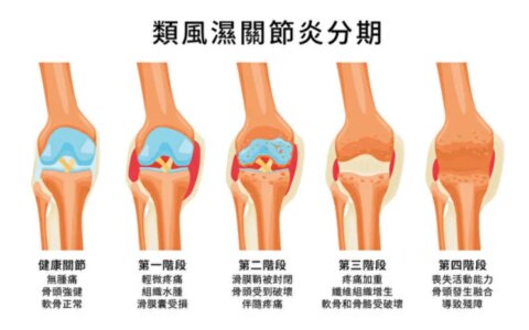 央视报道：干细胞终结11年类风湿